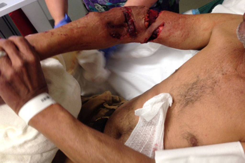 An image of Urbano Velazquezs arm after he was bitten by a King County Sheriffs Office K-9. It has been cropped to remove Velazquezs face. File photo